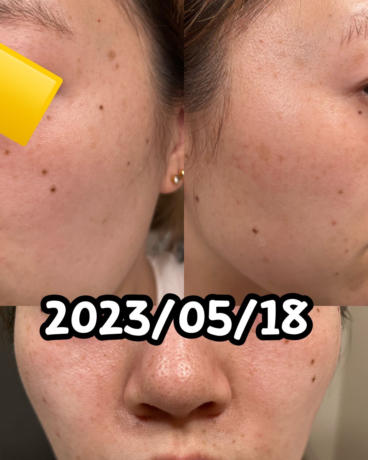 EUKROMA ハイドロキノンクリーム4% 20g/EUKROMA/その他スキンケアを使ったクチコミ(10枚目)