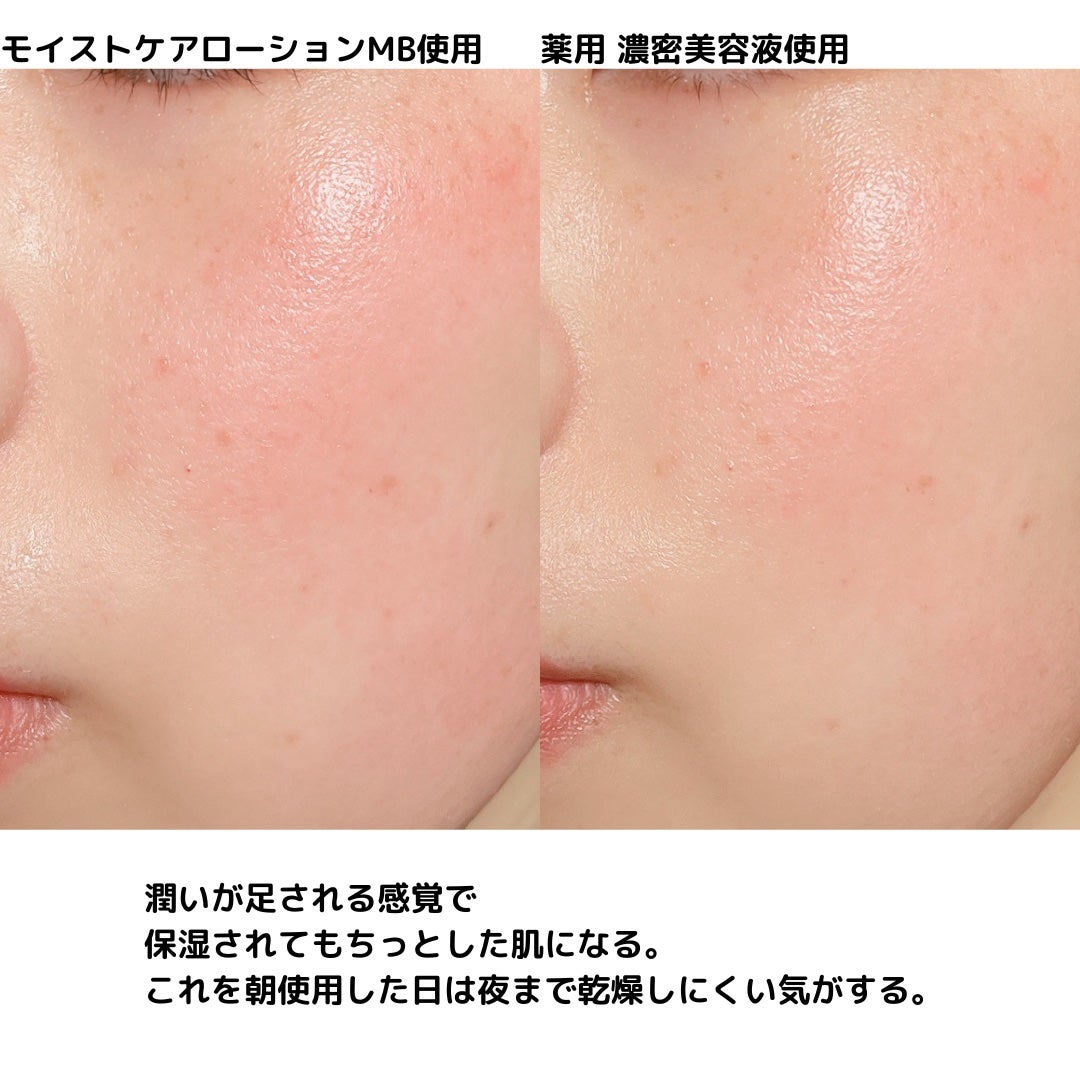 モイストケア ローション MB/d プログラム/化粧水を使ったクチコミ(10枚目)