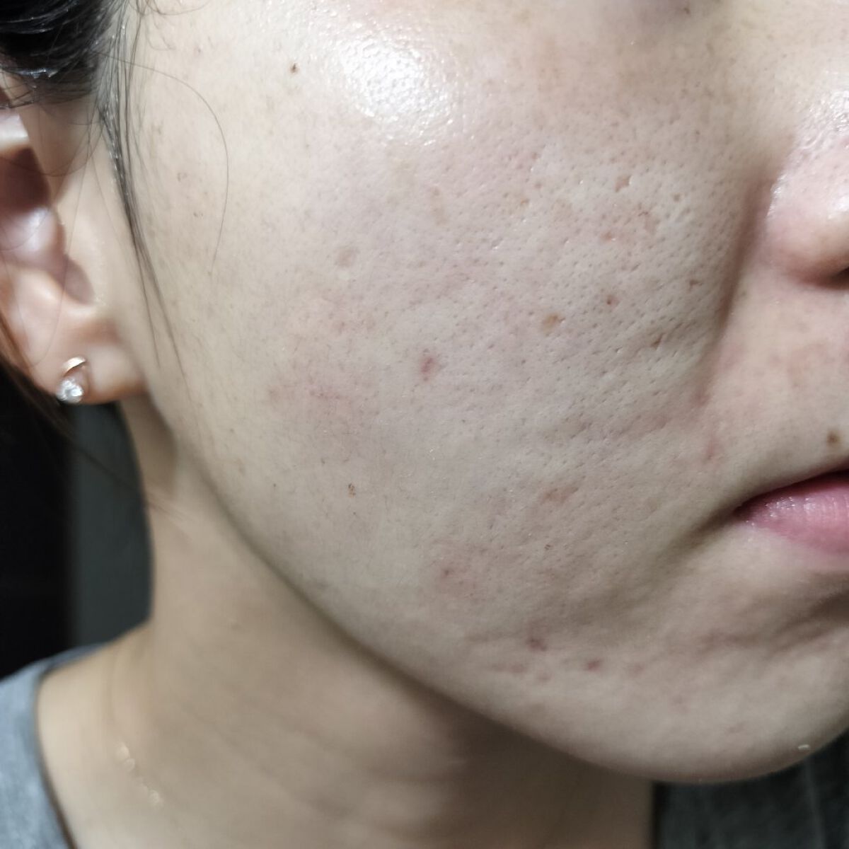 ティーツリーカーミングハイドロジェル/MEDIHEAL/ボディローションを使ったクチコミ（1枚目）