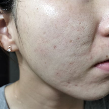 メラノフォーカスZ/HAKU/美容液を使ったクチコミ(1枚目)