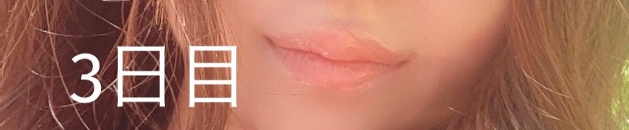 ãããœãð¡ãã©ãã100 on LIPS ãâåãã¢ã«ãã³é
žã¬ãã2æ¥ç®ã»3æ¥ç®ãäžæšæ¥å€æ¹ã«æã£ãŠç¥çµã..ãïŒ1æç®ïŒ