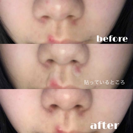 ACC パッチ/ETUDE/シートマスク・パックを使ったクチコミ(4枚目)