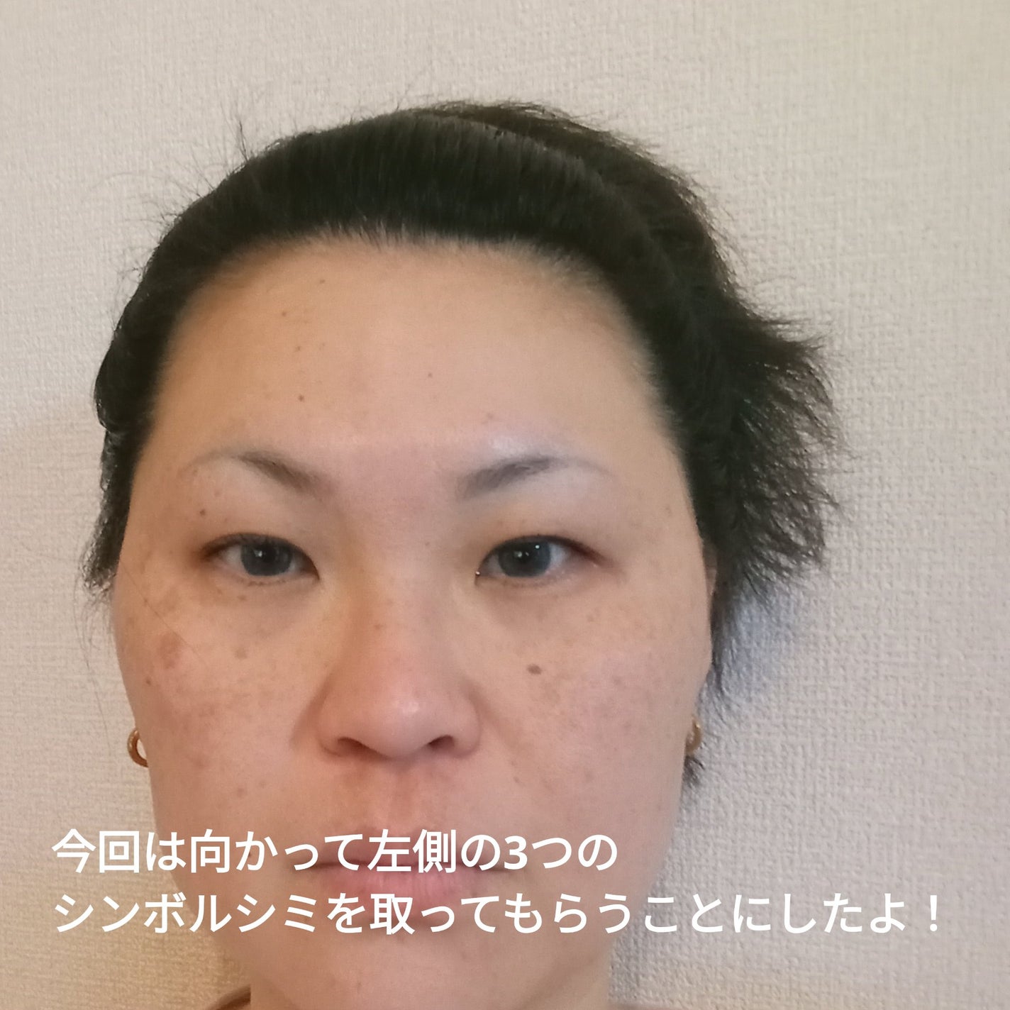 ビヨンセ奥二重向上委員長🥸LIPSパートナー🥳 on LIPS 「湘南美容クリニックでシミ取りレーザーしてきたよ!なんと3つで7..」(2枚目)