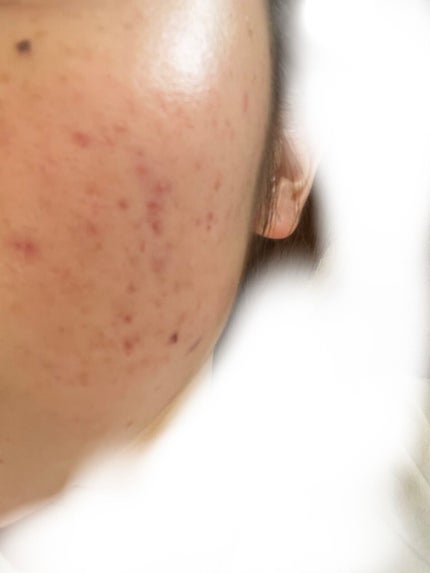 レチノールA 1% アドバンスドリバイタリゼーションクリーム/Life-flo/フェイスクリームを使ったクチコミ(1枚目)