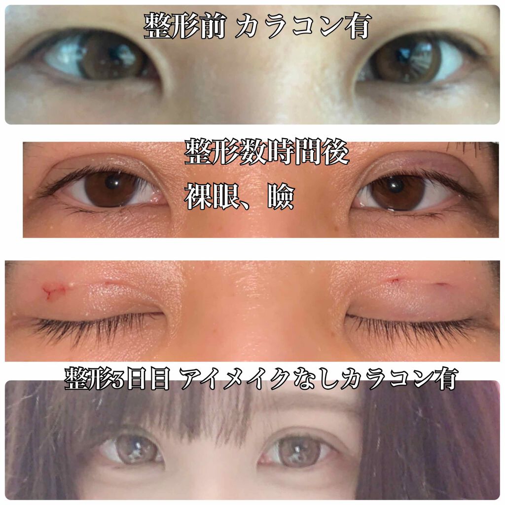 Sa on LIPS 「6月10日(水)に二重の埋没をしてきましたずっと、重たい奥2重..」(3枚目)