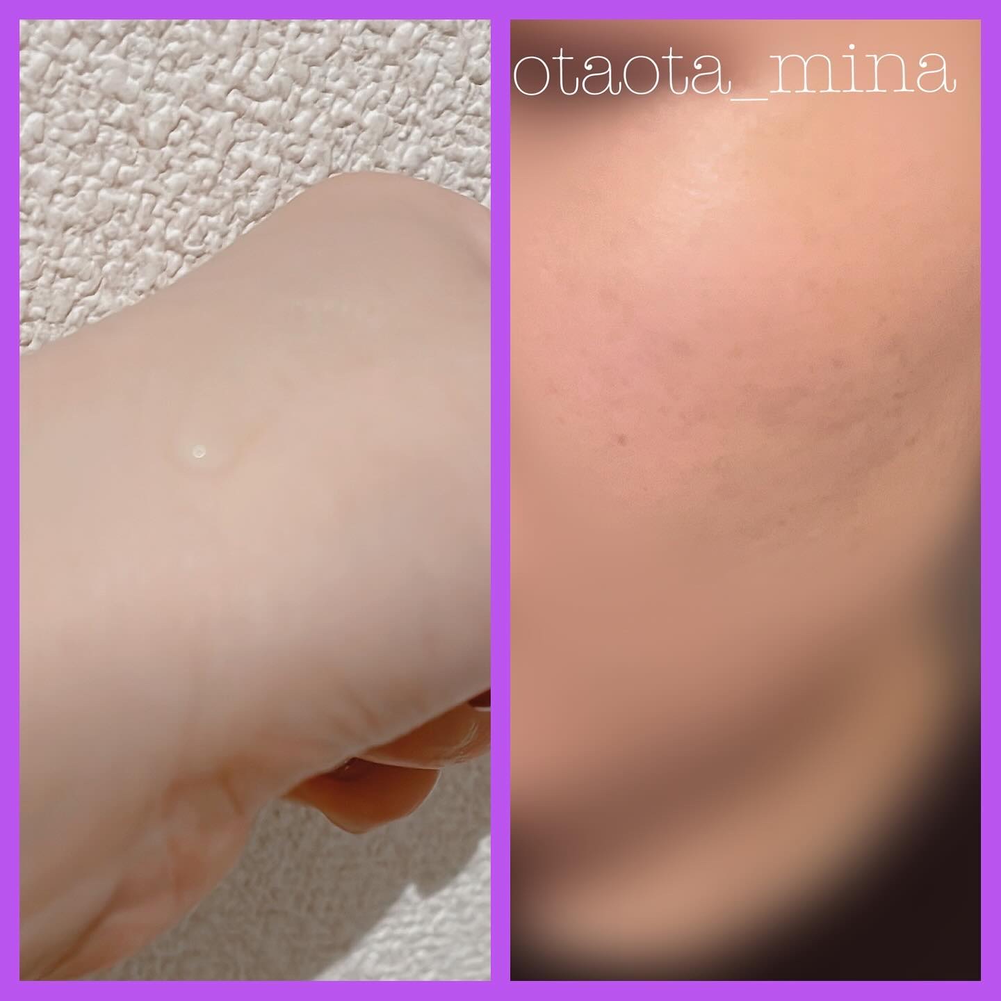 ナイアシンアミドブレミッシュケアセラム/ONE THING/美容液を使ったクチコミ（2枚目）