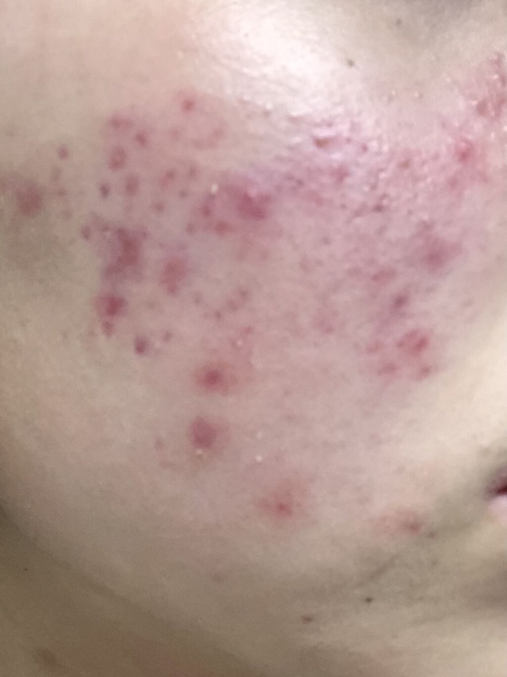 ビーソフテン ローション(医薬品)/持田製薬/その他を使ったクチコミ（2枚目）