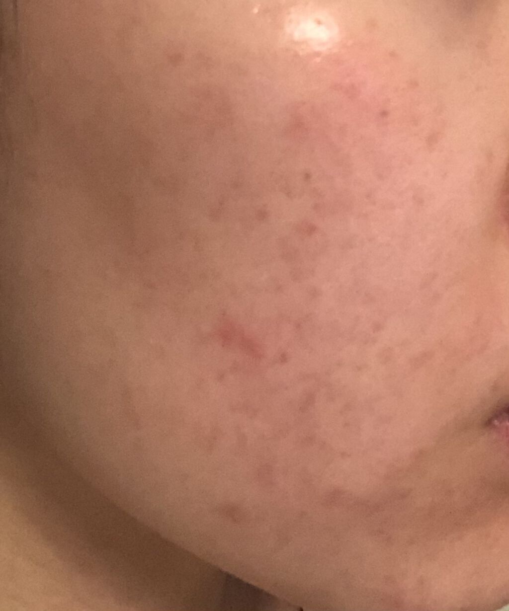 グリーンダーマCICAセラム/ネイチャーリパブリック/美容液を使ったクチコミ（2枚目）