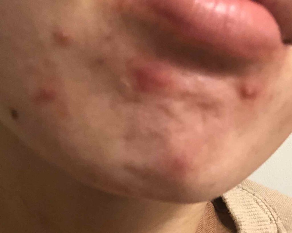 mama28 on LIPS 「#ガチレビュー#しこりニキビ#顎ニキビ#大人ニキビ#ベピオゲル..」(3枚目)