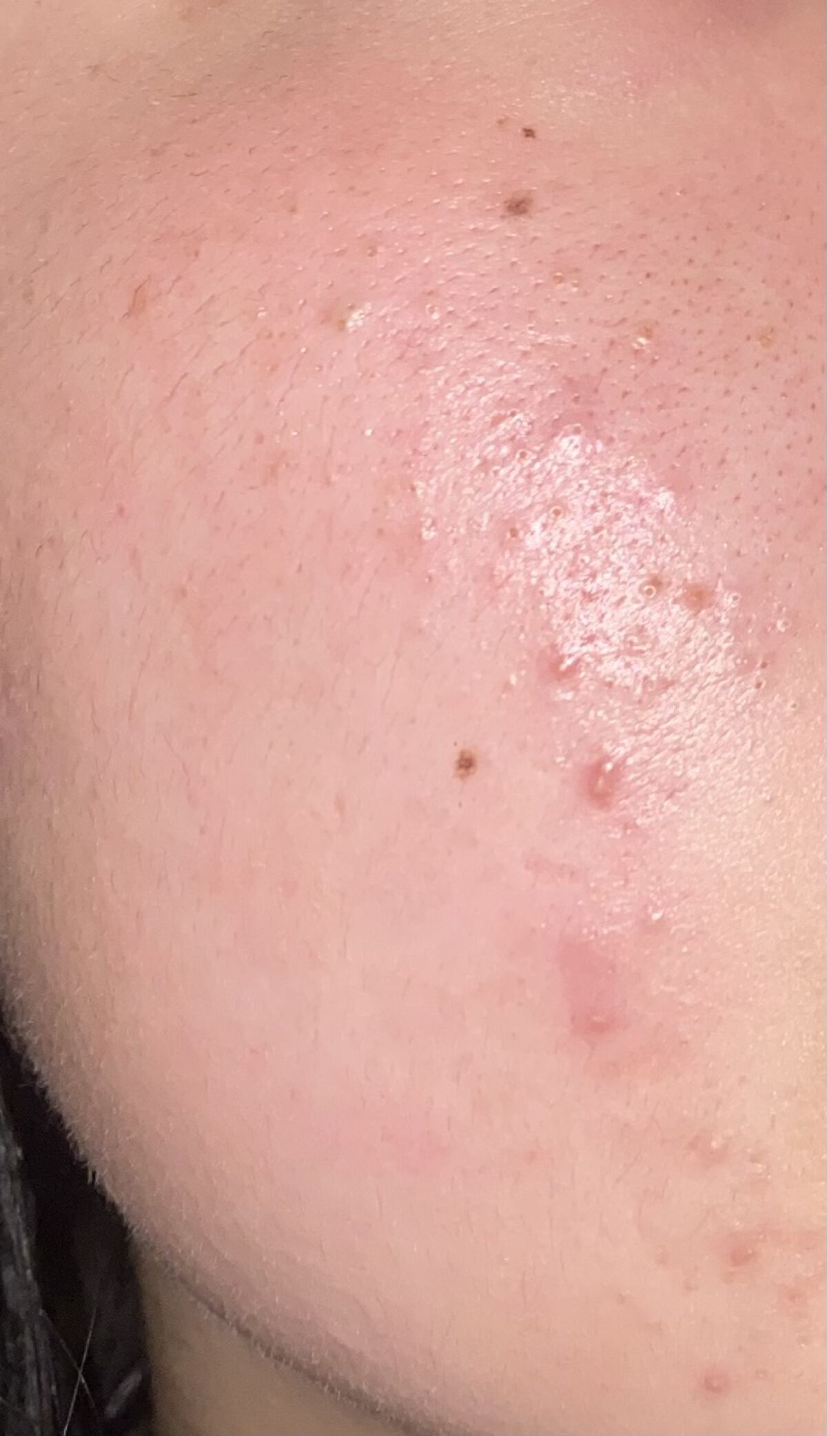 ACアクティブ トライアルセット/NOV/トライアルキットを使ったクチコミ（2枚目）