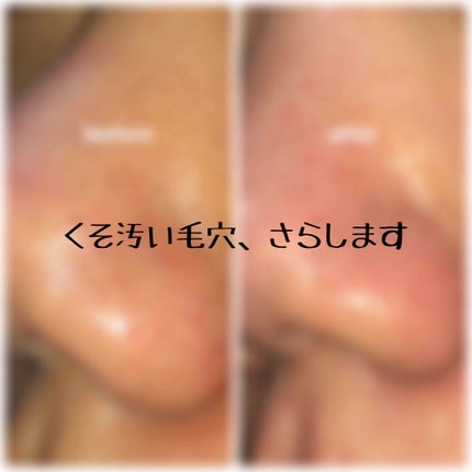 ツルリ 皮脂吸い出し 部分用パック ガスール&レッドパワー/ツルリ/洗い流すパック・マスクを使ったクチコミ(1枚目)