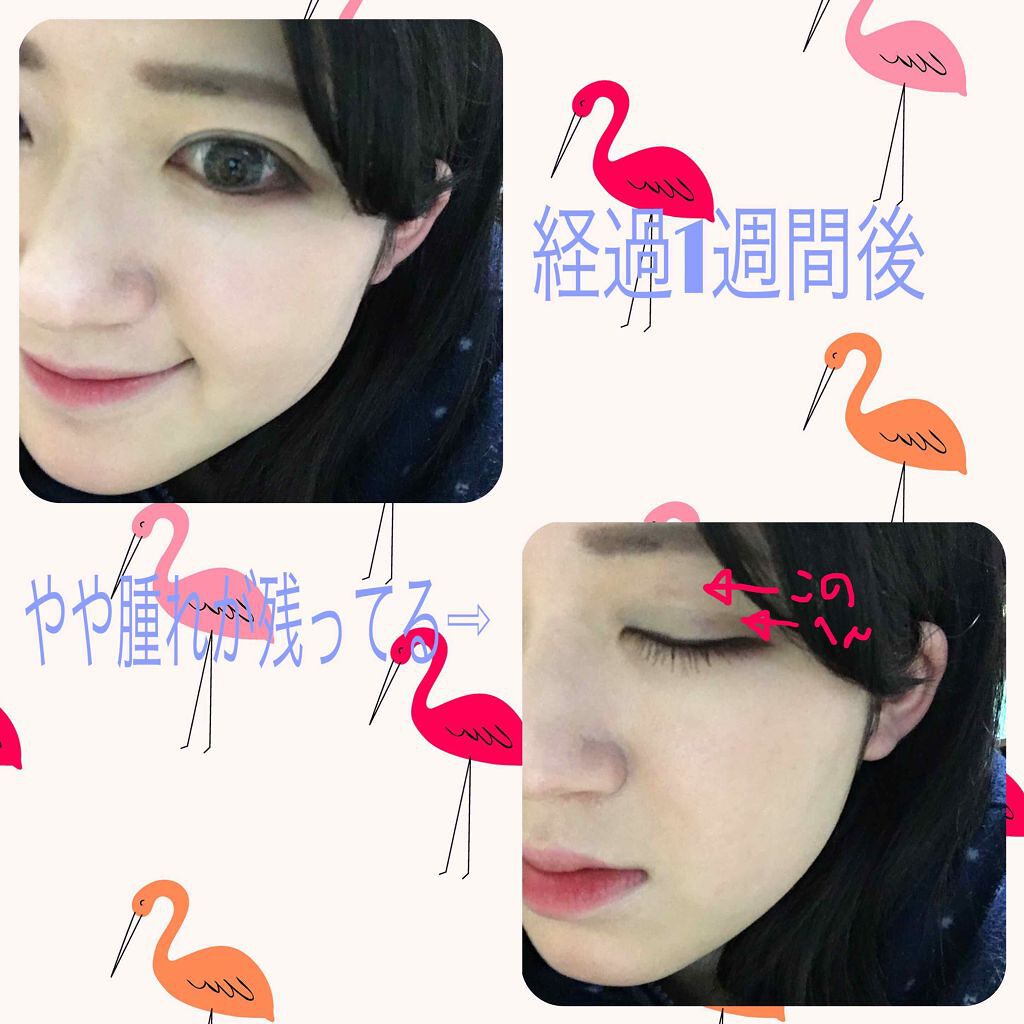 二重整形/その他を使ったクチコミ（2枚目）