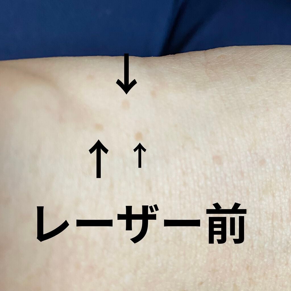 ためしたがり43歳 on LIPS 「レーザーペン!手の甲の平たいイボが無数にある私。焼きてーなー、..」(5枚目)