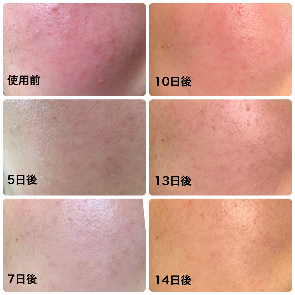 薬用 しみ 集中対策 美容液/メラノCC/美容液を使ったクチコミ（3枚目）