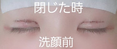 さや on LIPS 「ご覧頂きありがとうございます。ダウンタイム2日目と3日目です。..」（3枚目）