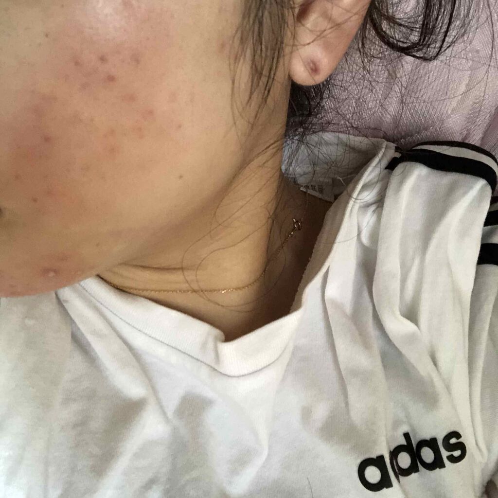 エピデュオゲル/マルホ株式会社/その他を使ったクチコミ（3枚目）