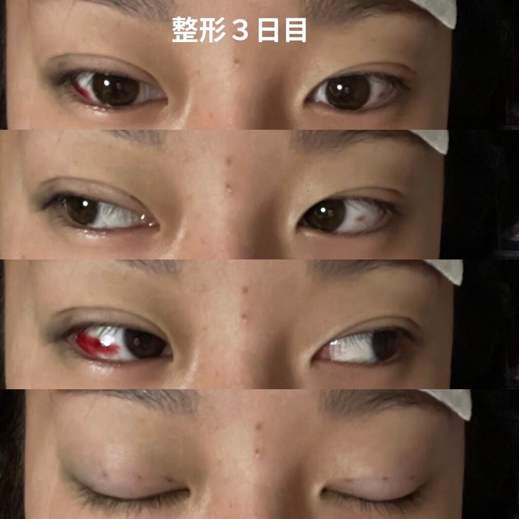 なつ on LIPS 「二重整形(埋没)しました整形記録1閲覧注意2日目〜 右目眼球内..」(4枚目)