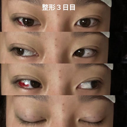 なつ on LIPS 「二重整形(埋没)しました整形記録1閲覧注意2日目〜 右目眼球内..」(4枚目)