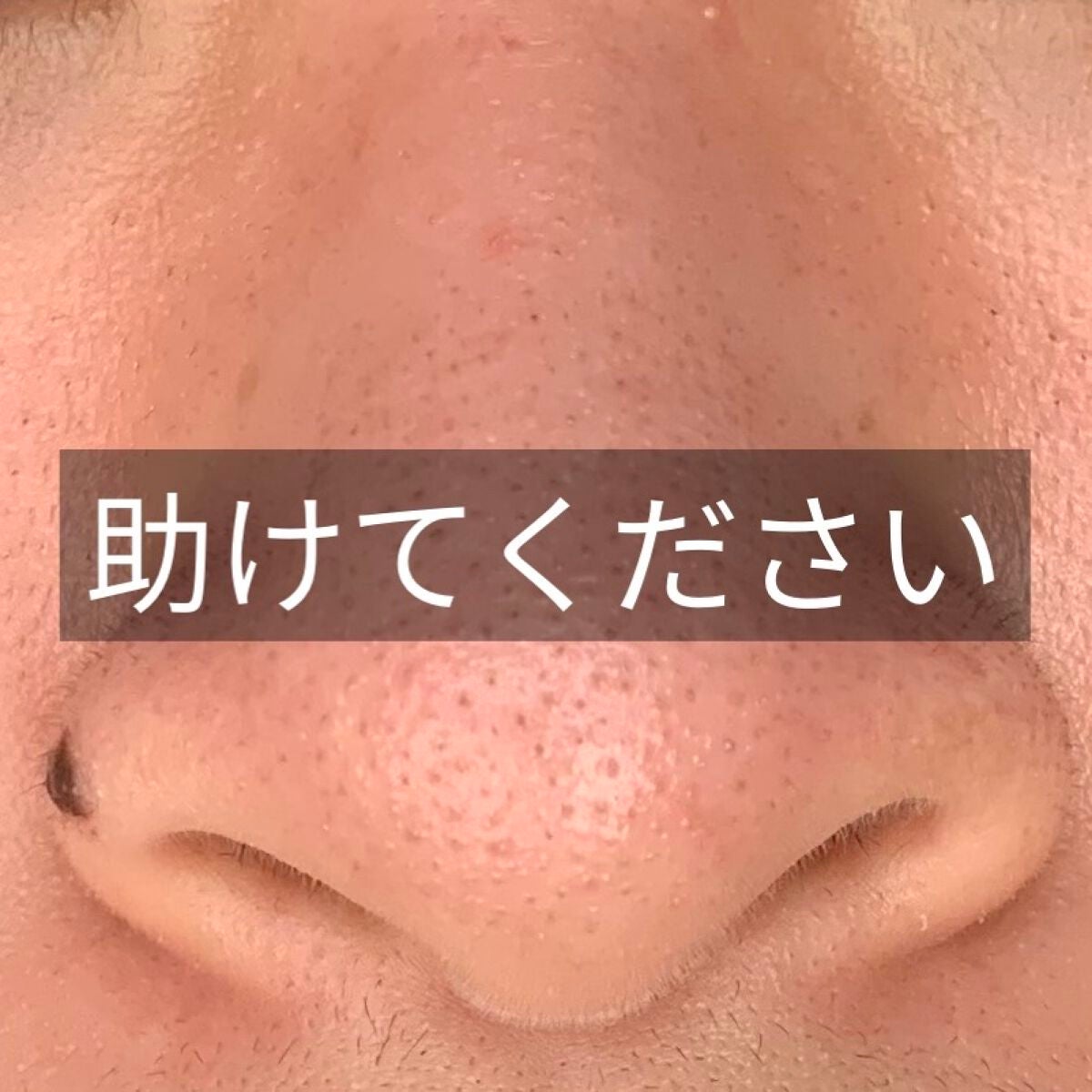 こん@フォロバ on LIPS 「助けてください...!前からなのですが鼻の毛穴詰まりがすごいん..」(1枚目)