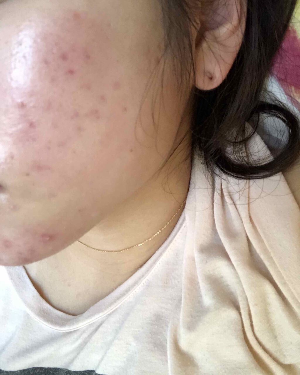 エピデュオゲル/マルホ株式会社/その他を使ったクチコミ（3枚目）