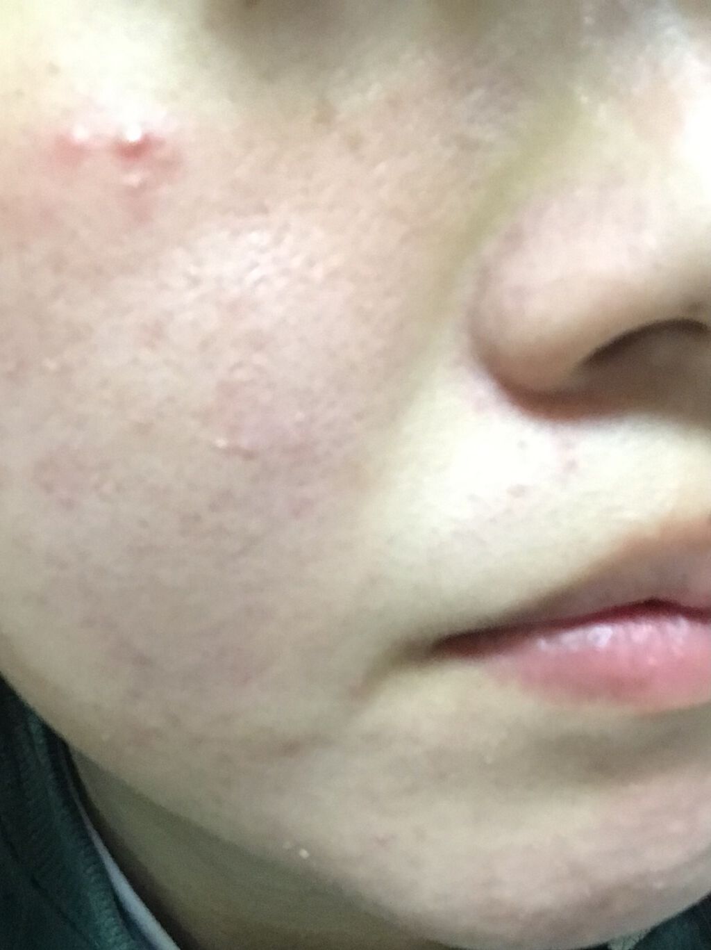 エピデュオゲル/マルホ株式会社/その他を使ったクチコミ（1枚目）