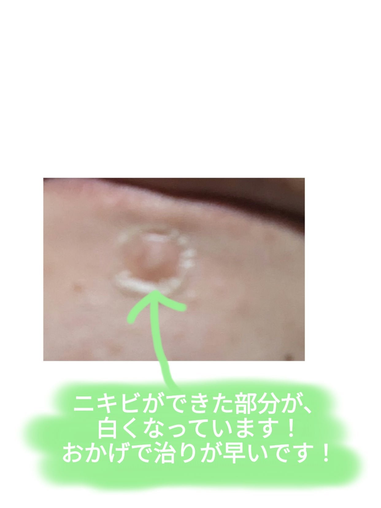 プロCICA クリアスポットパッチ/VT/その他スキンケアを使ったクチコミ(3枚目)