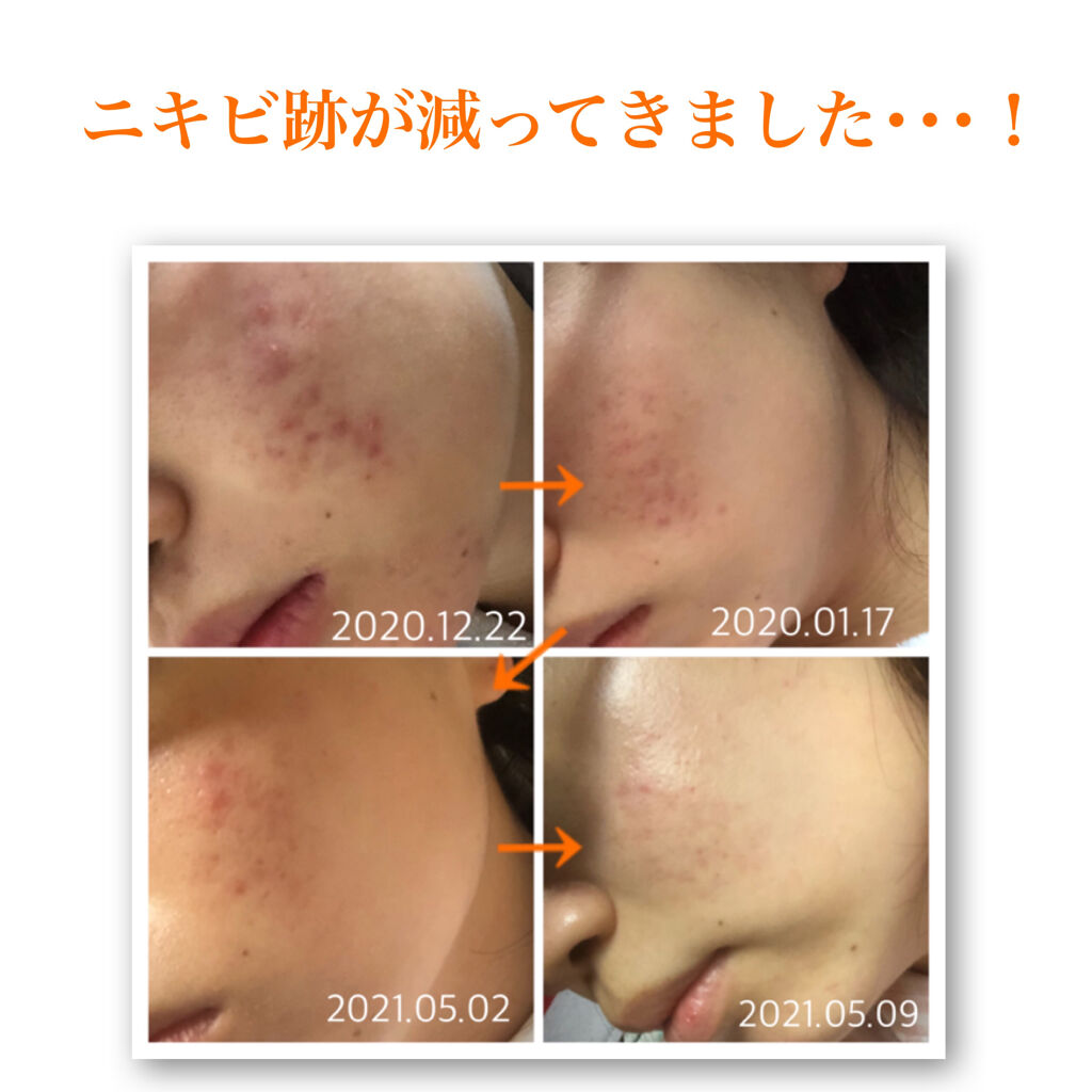 潤浸保湿 化粧水 III とてもしっとり/キュレル/化粧水を使ったクチコミ（1枚目）