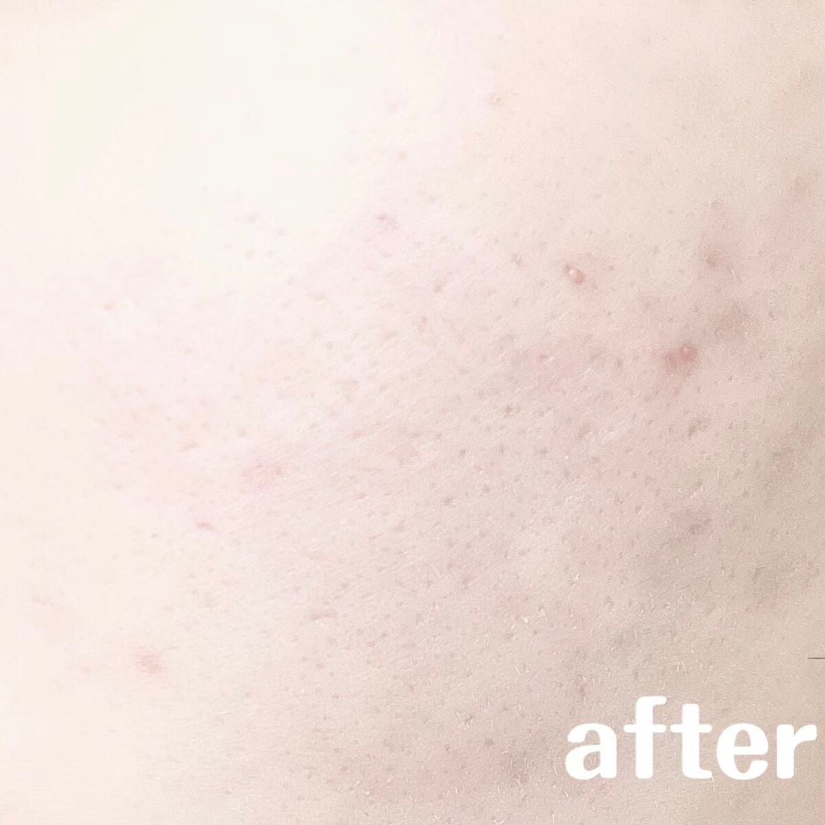 綴 on LIPS 「【肌断食で驚きの結果に!?】こんにちは、綴です🙌🏻つい最近コロ..」(3枚目)