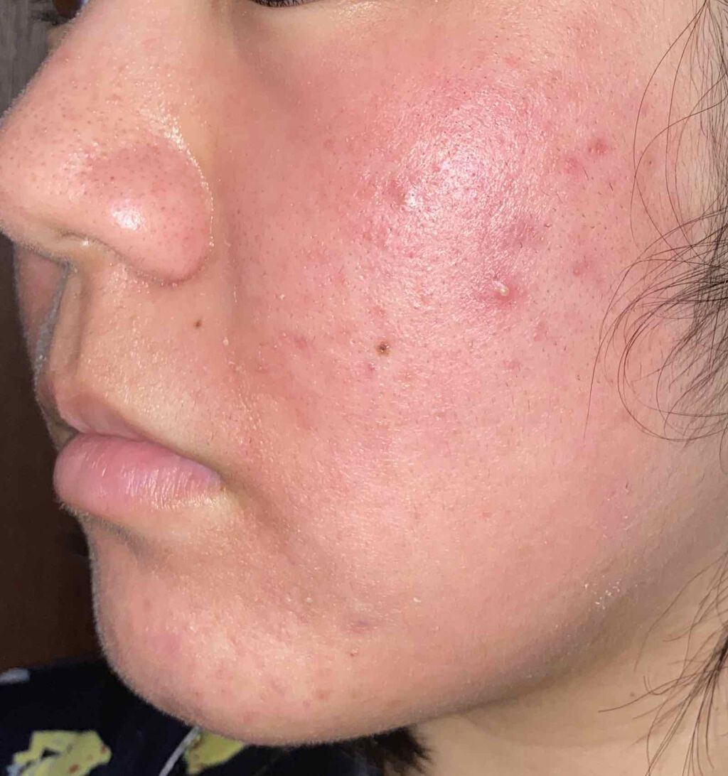 ベピオゲル/マルホ株式会社/その他を使ったクチコミ（3枚目）