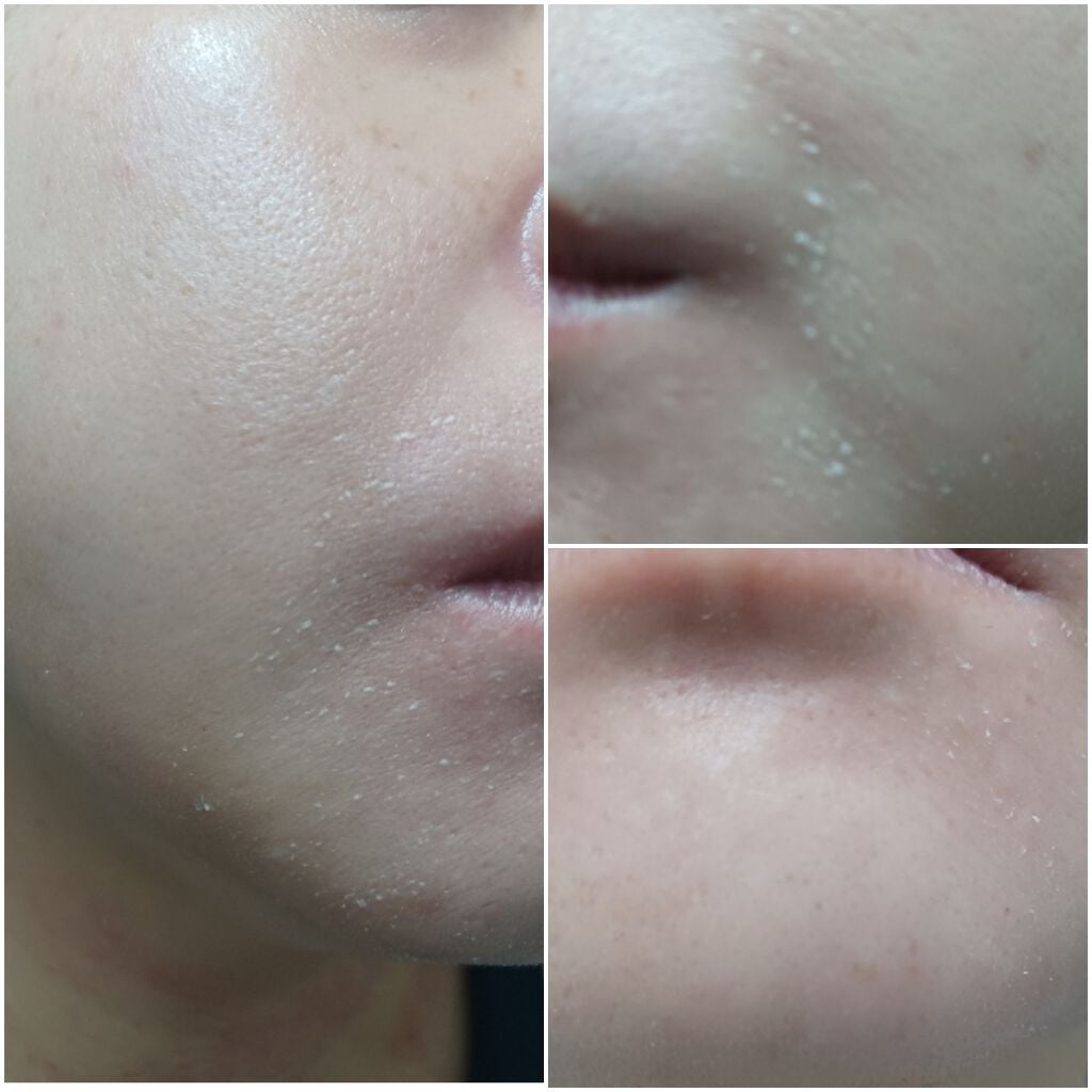 バブ美 on LIPS 「ゼオスキンセラピューティック2週目の様子です。8日目頬の皮剥け..」(4枚目)