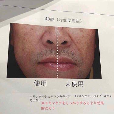 リンクルショット メディカル セラム リンクルショットの使い方を徹底解説 一度浮気してまた戻ったら驚異のスピードで目 By Miri みり 混合肌 Lips