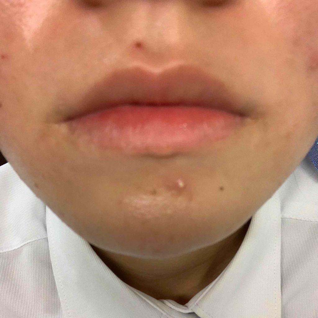 エピデュオゲル/マルホ株式会社/その他を使ったクチコミ（2枚目）