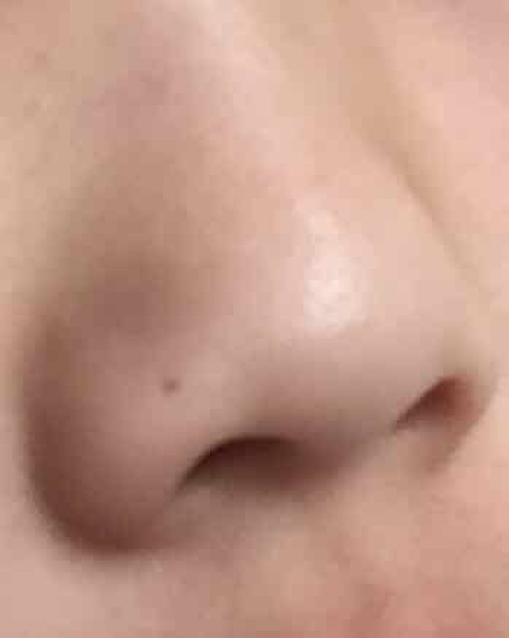 TOWA on LIPS 「皆さん!この鼻のホクロ消せませんか?出来るだけ低コストでできる..」(1枚目)