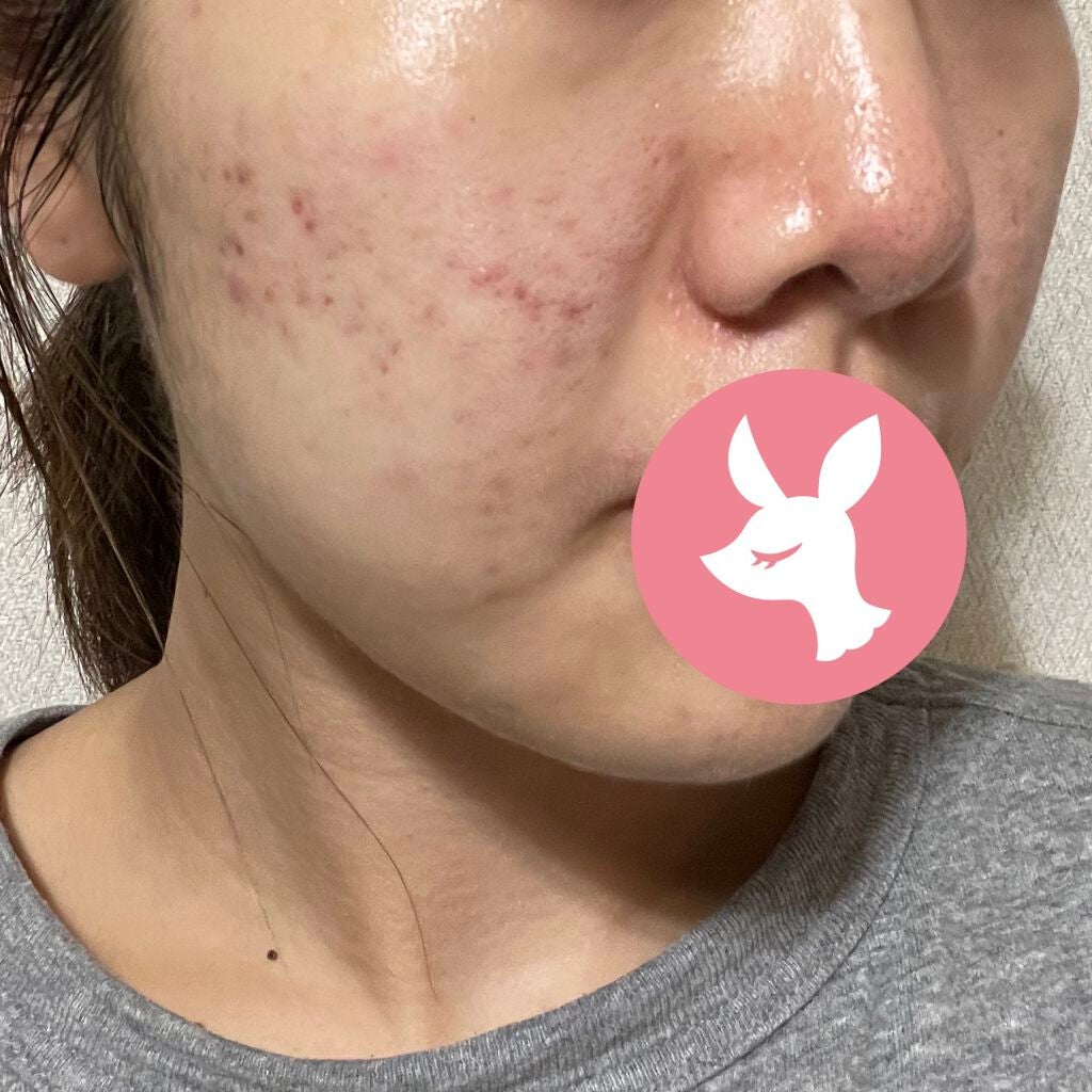 たべっこ on LIPS 「9/6(月)☀️夜整形外科でダーマペンとか勧められるかな思った..」(3枚目)