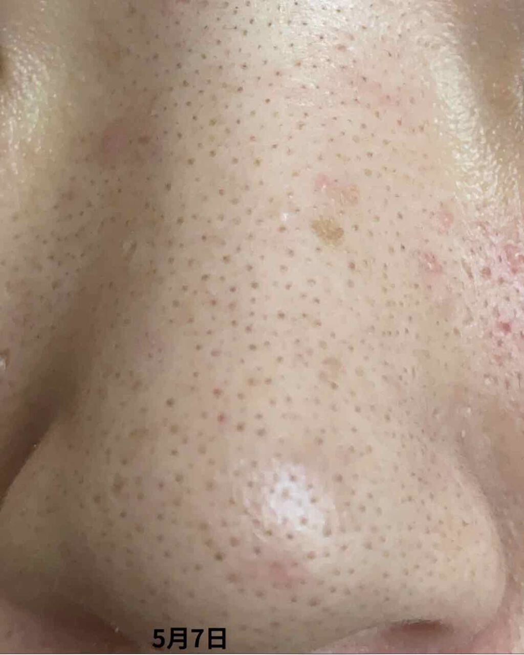 ! on LIPS 「皮膚科処方薬約2週間経過にきびはまだまだ残ってます😭でも!!鼻..」(3枚目)
