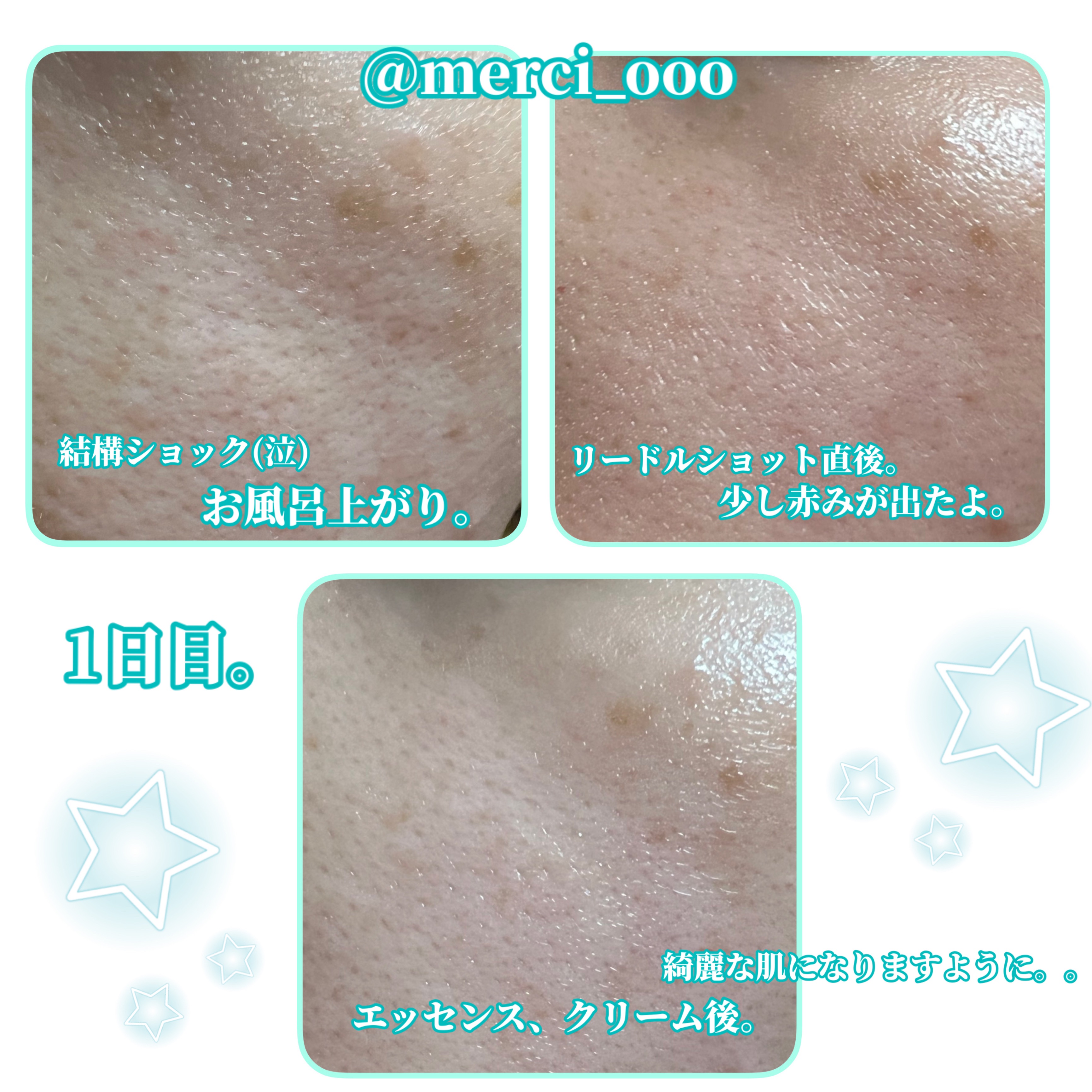 TXトーニングエッセンス1000SHOT/VT/美容液を使ったクチコミ（3枚目）