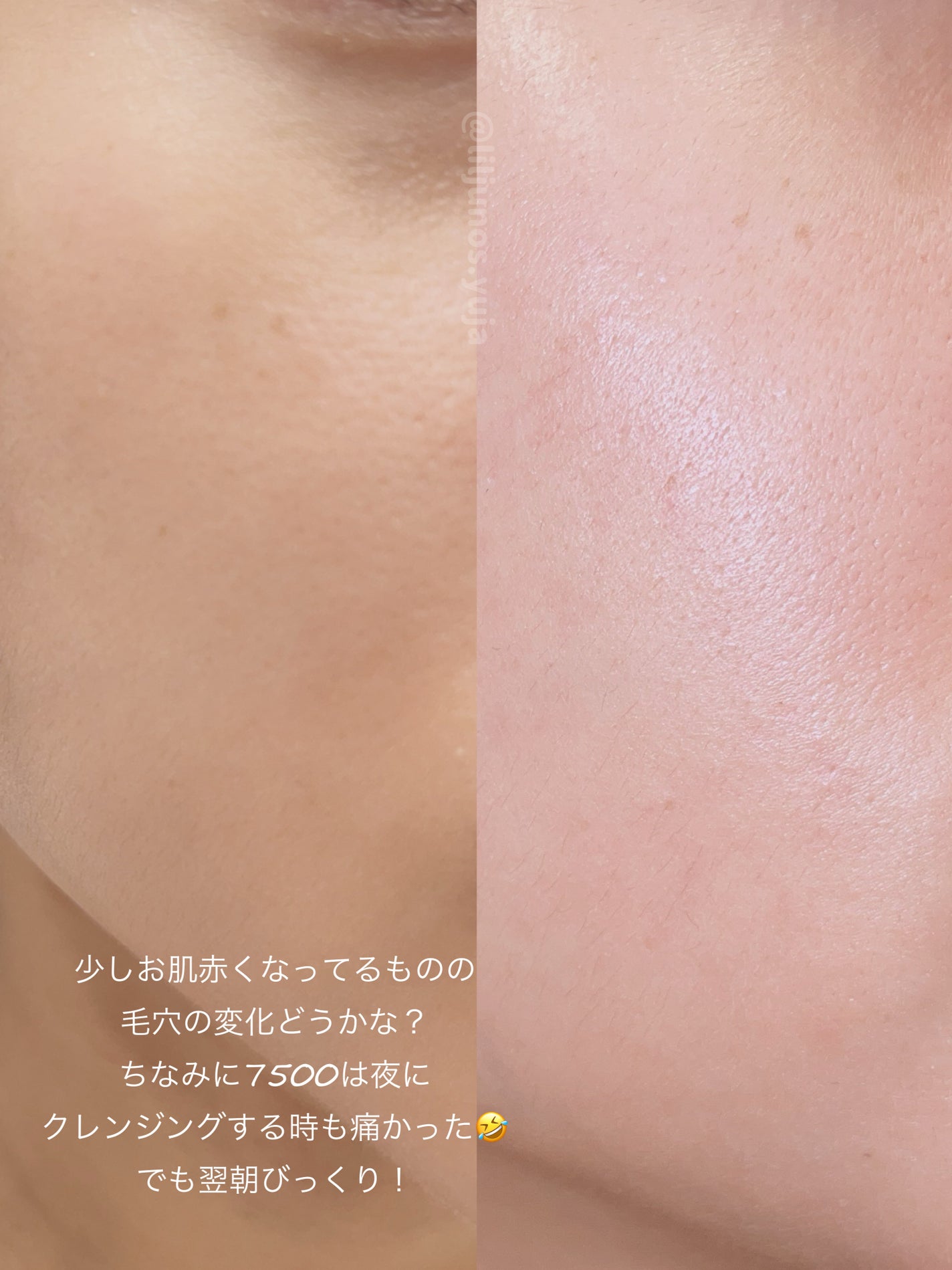 ゼロ1DAYエクソソームショット2000/MEDICUBE/美容液を使ったクチコミ(4枚目)