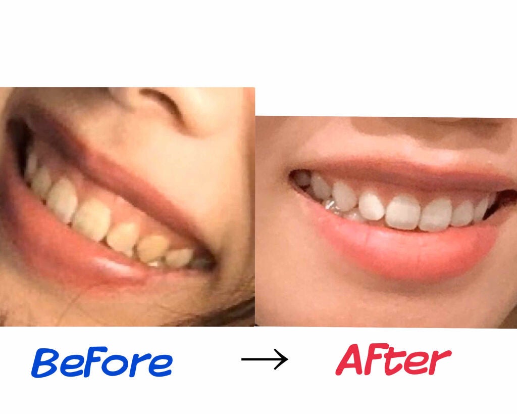 プレミアム ステインクリア ペースト/オーラツー/歯磨き粉を使ったクチコミ(2枚目)