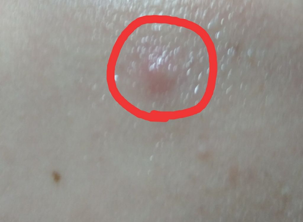 薬用3ステップセット30日サイズ/プロアクティブ/トライアルキットを使ったクチコミ(1枚目)