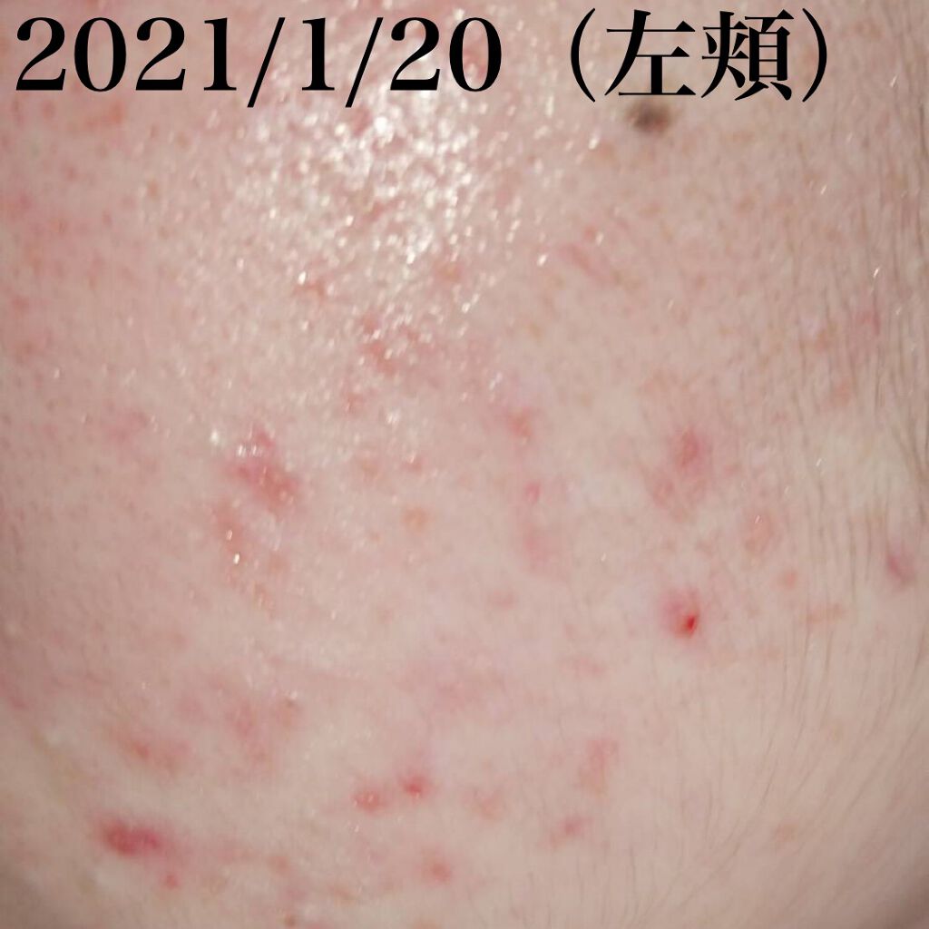 楓@LIPSパートナー on LIPS 「#ニキビスキンケア初投稿です。いきなり黒歴史を公開いたします笑..」(5枚目)