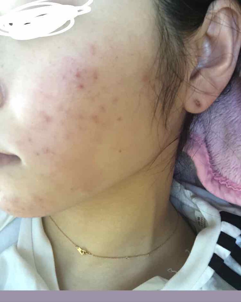 エピデュオゲル/マルホ株式会社/その他を使ったクチコミ（3枚目）