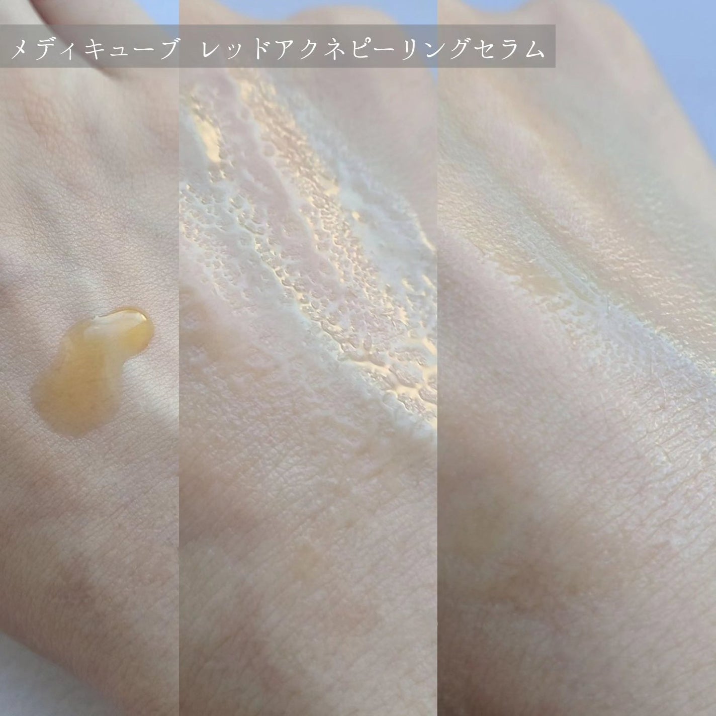 レッドアクネピーリングセラム/MEDICUBE/美容液を使ったクチコミ(2枚目)