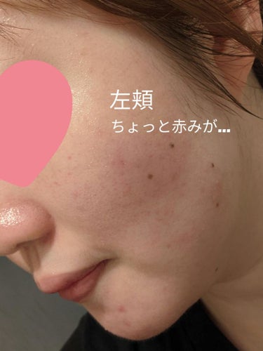 まいなん on LIPS 「🙇🏻‍♀️去年の夏に炎症してからの途中経過1～3枚目は今現在の..」（2枚目）