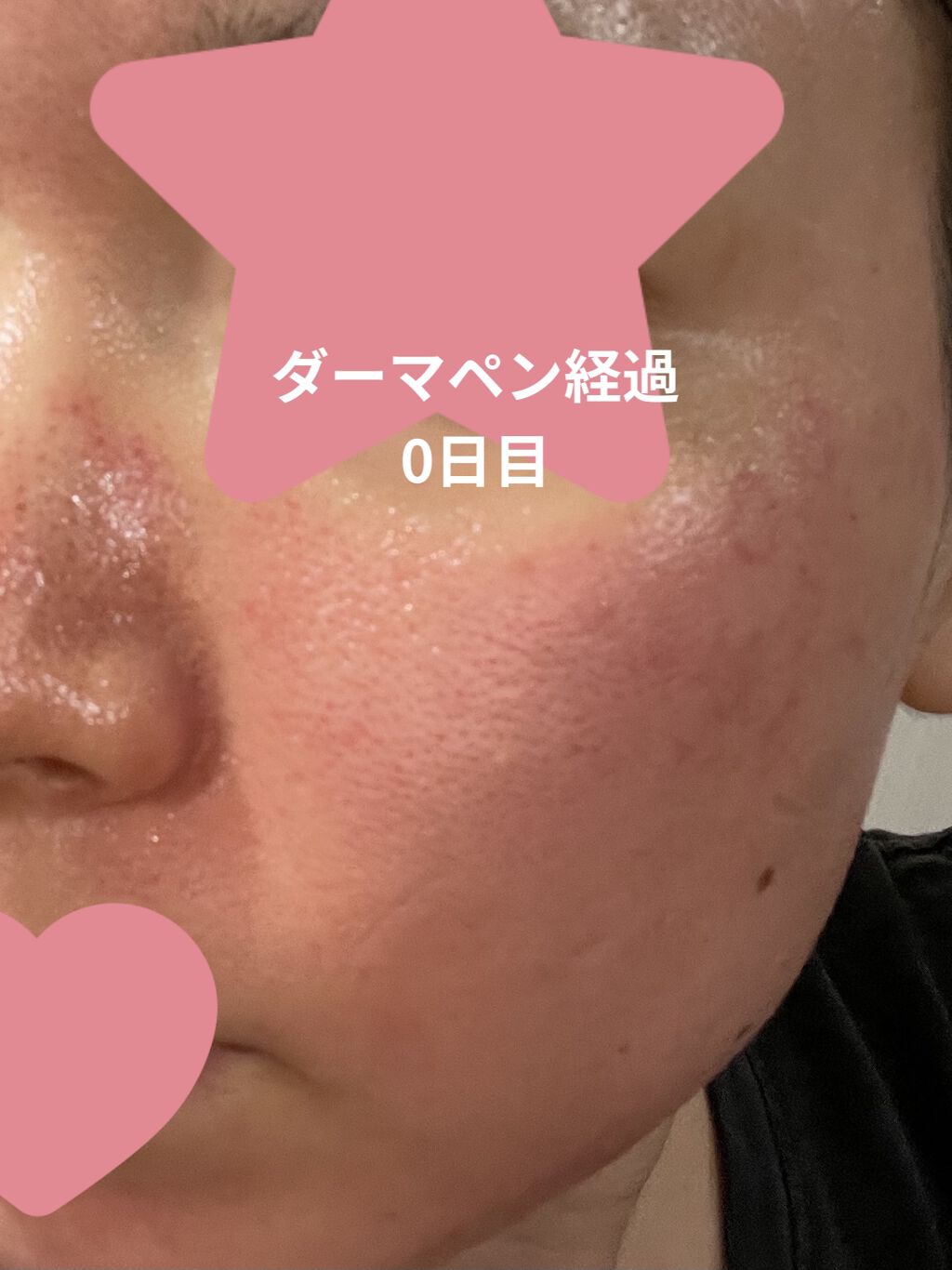 なかなかグロ注意！！

ダーマペン経過
記録していきたいと思います

#ダーマペン
#臍帯由来幹細胞培養上清液
を行いました

ベルヴェットスキンの予定が
毛穴が広がりすぎ、、なのでダーマペンのみプラス美容液を勧められて変更しました
正直ダ