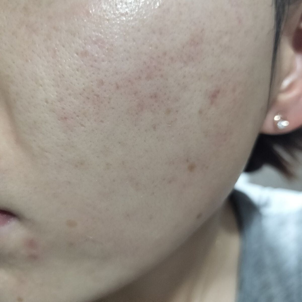 miina@汚肌工事録⚠️ on LIPS 「10/17の#汚肌工事録ありがとう❤/なんとなく赤み見える。ス..」(2枚目)