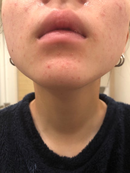 肌荒れ女子 on LIPS 「【閲覧注意⚠️】肌荒れ女子の肌断食日記📖2日目・・・・こんにち..」(4枚目)