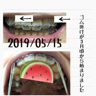 ちゃむまる on LIPS 「#283の歯科矯正レポさて第四回目です！見なくていいですけどタ..」（2枚目）