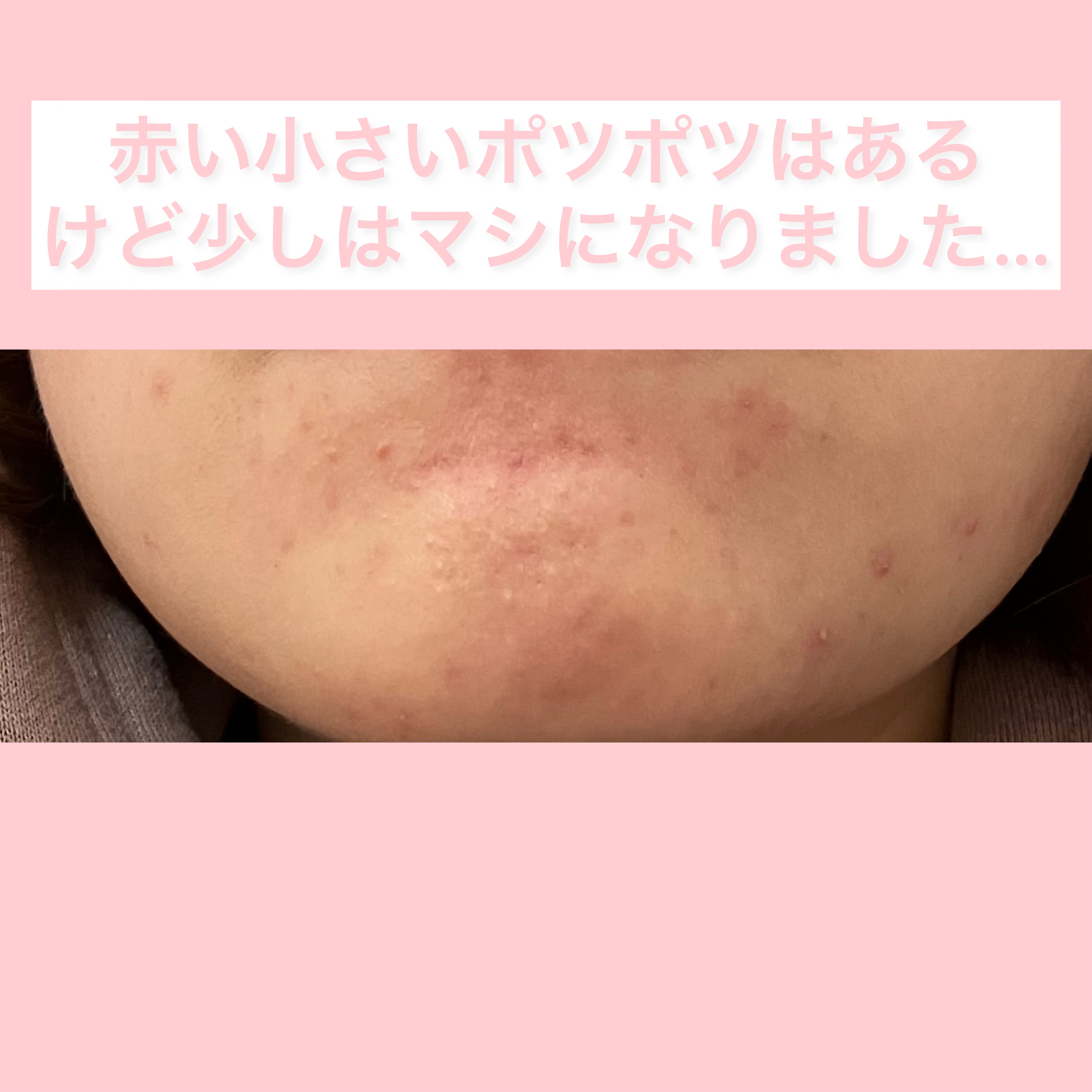 エクオール/小林製薬/健康サプリメントを使ったクチコミ（1枚目）