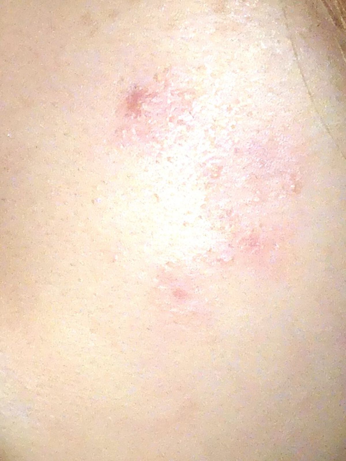 デュアック配合ゲル/医薬品/その他スキンケアを使ったクチコミ（3枚目）