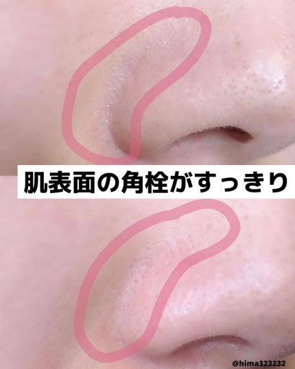 ひまちゃん /垢抜けの参考書 on LIPS 「【超手軽】〜気になった時にすぐ使える!TBCの角質ケア〜。.。..」(4枚目)